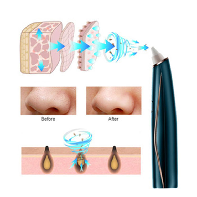 Pore ​​Acne Cleansing Electric Blackhead Remover